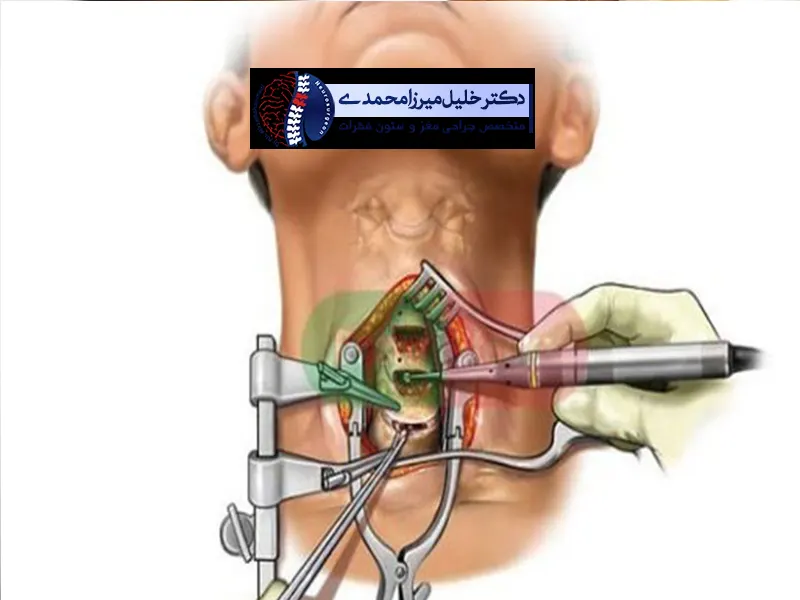 جراحی-دیسک-گردن