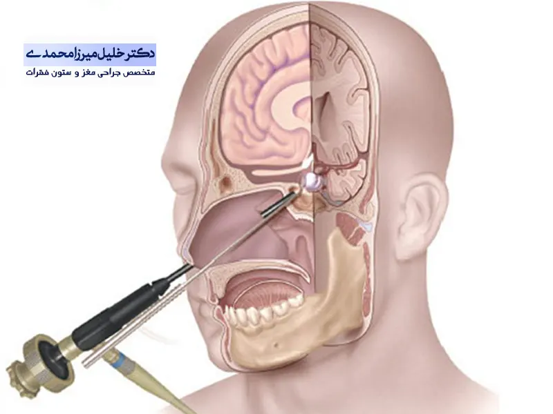 درمان قاعده جمجمه