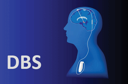 تحریک عمیق مغز (DBS)