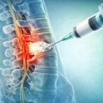 کیفوپلاستی