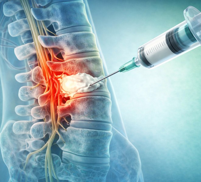 کیفوپلاستی