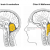 سندرم کیاری چیست؟